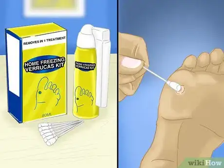 Image intitulée Remove Verrucas Step 1
