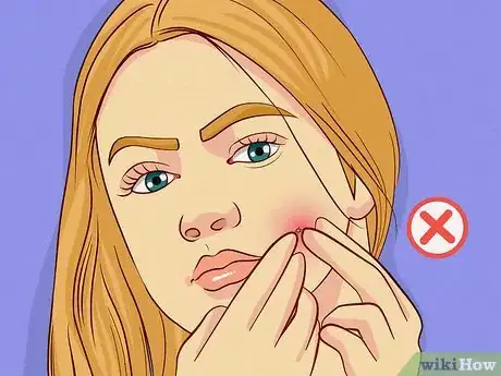 Image intitulée Get Rid of Acne Redness Step 13