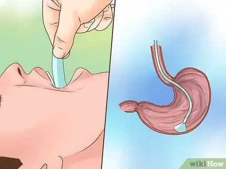 Image intitulée Treat a Hiatal Hernia Step 2