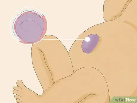 Image intitulée Treat Constipation After Hernia Surgery Step 15