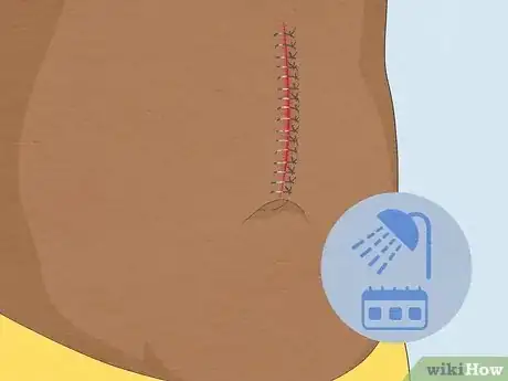 Image intitulée Take a Shower After Surgery Step 7