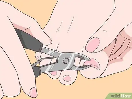 Image intitulée Fix Thick Toenails Step 2