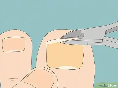 Image intitulée Remove a Dead Toenail Step 8
