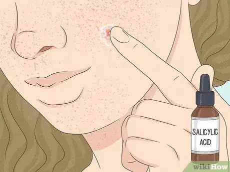 Image intitulée Get Rid of a Zit Overnight Step 3