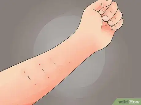 Image intitulée Tell if a Tattoo Is Infected Step 9