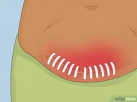 Image intitulée Take a Shower After Surgery Step 14