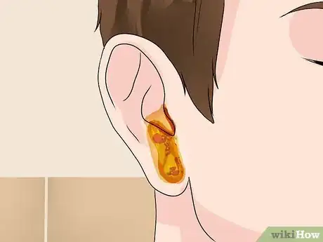 Image intitulée Treat an Outer Ear Infection Step 2