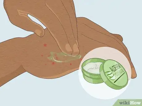 Image intitulée Treat Sand Flea Bites Step 3