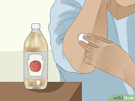 Image intitulée Get Rid of Skin Tags Step 13