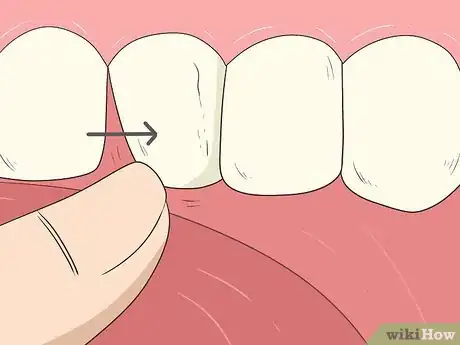 Image intitulée Pull a Loose Tooth at Home Step 1