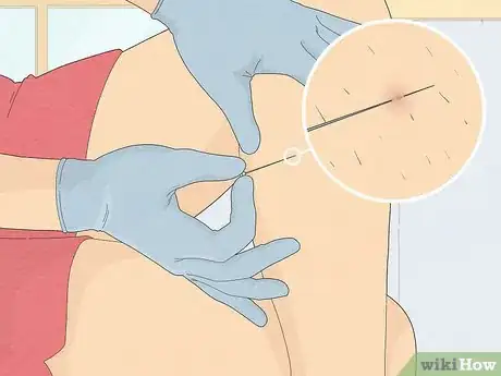 Image intitulée Remove an Ingrown Hair Under the Skin Step 8