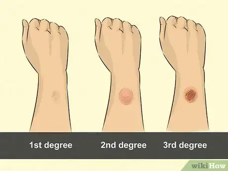 Image intitulée Use Aloe Vera to Treat Burns Step 2