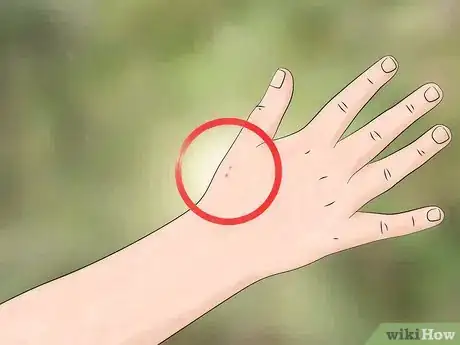 Image intitulée Identify and Treat Black Widow Spider Bites Step 1