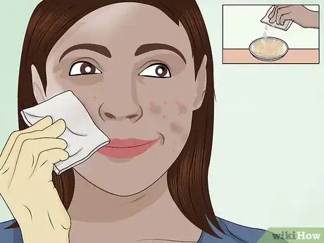 Image intitulée Apply a TCA Peel Step 11
