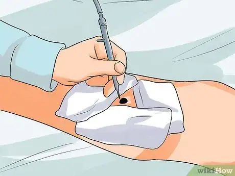 Image intitulée Remove a Raised Mole Step 5