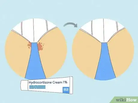 Image intitulée Get Rid of a Rash Between Your Legs Step 21