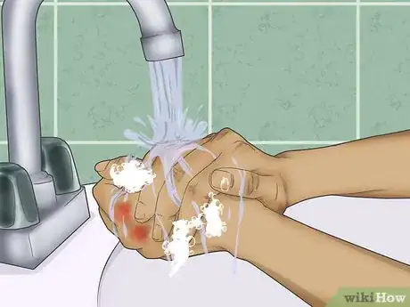 Image intitulée Treat Wax Burns Step 5