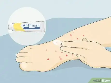 Image intitulée Treat Sand Flea Bites Step 9