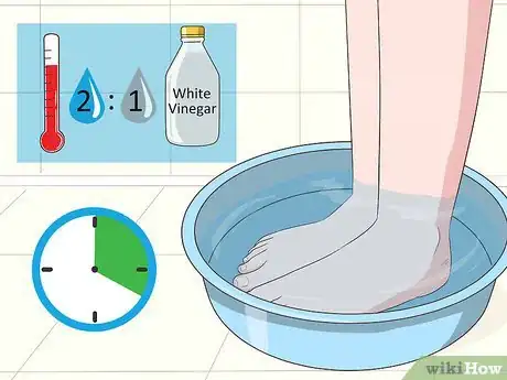 Image intitulée Treat Toe Nail Fungus Step 4
