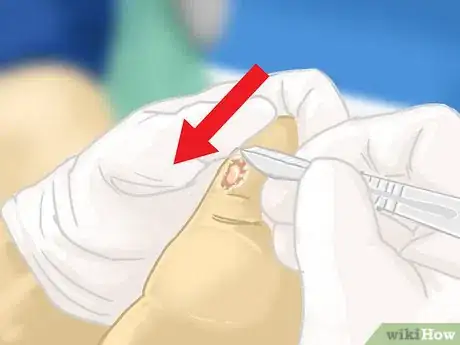 Image intitulée Remove Verrucas Step 13