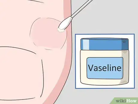 Image intitulée Treat a Foot Blister Step 10