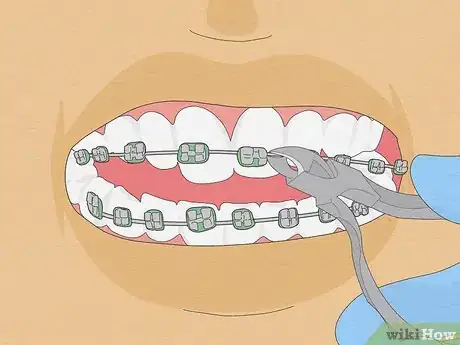 Image intitulée Fix Crooked Teeth Step 25