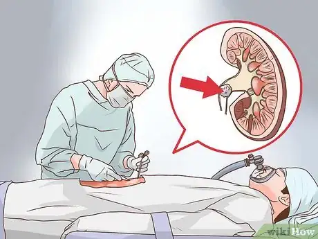 Image intitulée Know if You Have Kidney Stones Step 13