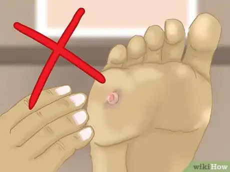 Image intitulée Remove Verrucas Step 20