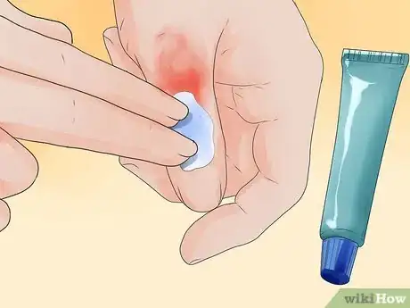 Image intitulée Treat Carpet Burns Step 4