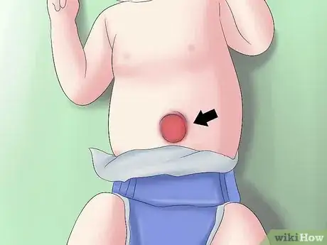 Image intitulée Treat a Hernia at Home Step 22
