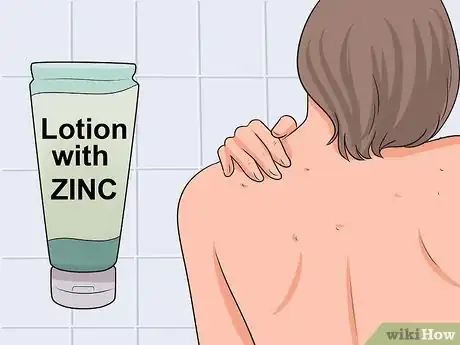 Image intitulée Get Rid of Bacne Step 8