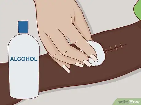 Image intitulée Remove Surgical Staples Step 1
