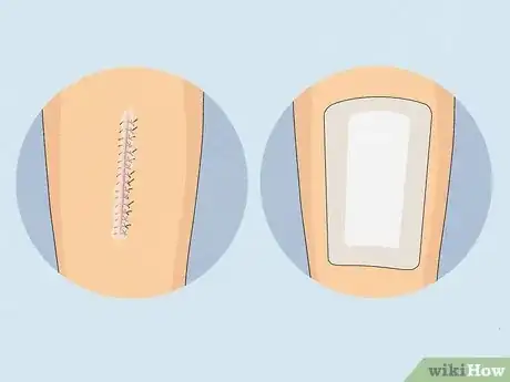 Image intitulée Take a Shower After Surgery Step 5