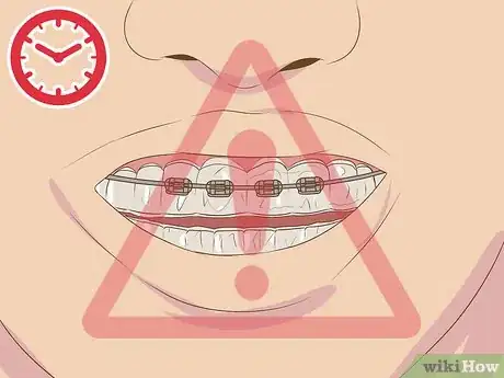 Image intitulée Make Fake Braces or a Fake Retainer Step 19