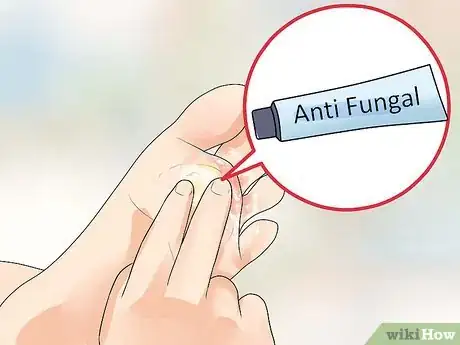 Image intitulée Know if You Have Athlete's Foot Step 9