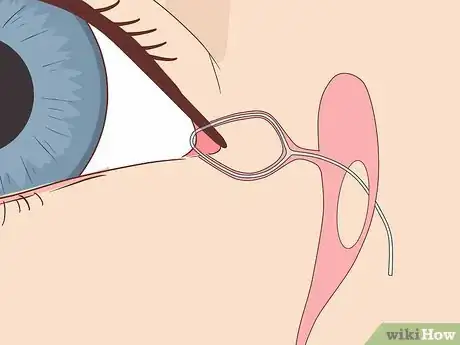 Image intitulée Clear a Blocked Tear Duct Step 12