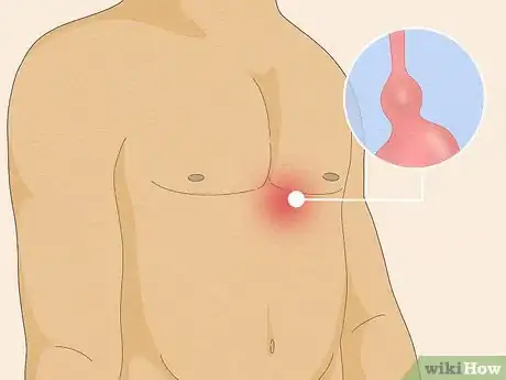 Image intitulée Treat Constipation After Hernia Surgery Step 14