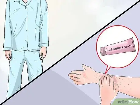 Image intitulée Live With Shingles Step 3