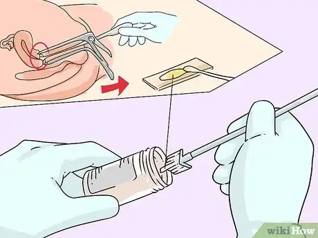 Image intitulée Recognize Cervical Cancer Symptoms Step 11