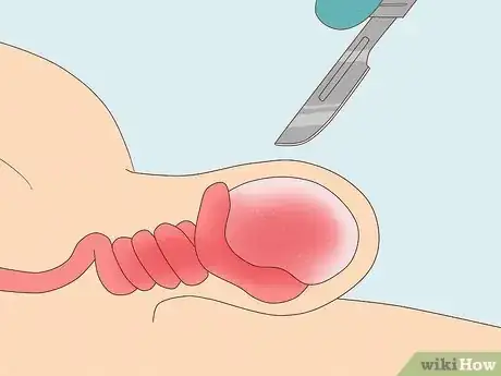 Image intitulée Treat Pain and Swelling in the Testicles Step 18