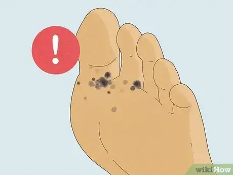 Image intitulée Treat Sand Flea Bites Step 7