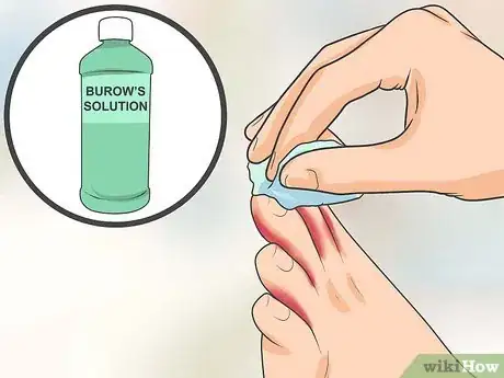 Image intitulée Treat Athlete's Foot Step 11