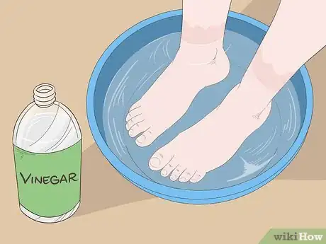 Image intitulée Cure Athlete's Foot Naturally Step 3