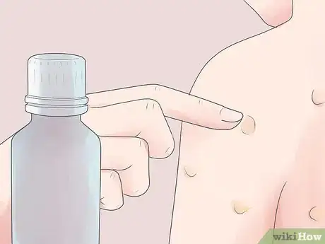 Image intitulée Treat Chickenpox at Home Step 23