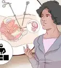 détecter une grossesse extra utérine