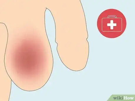 Image intitulée Treat Pain and Swelling in the Testicles Step 17