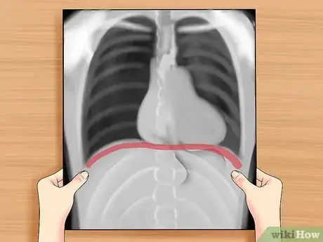 Image intitulée Read a Chest X Ray Step 17