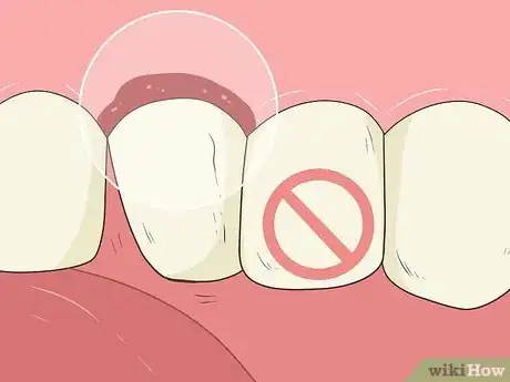 Image intitulée Pull a Loose Tooth at Home Step 3