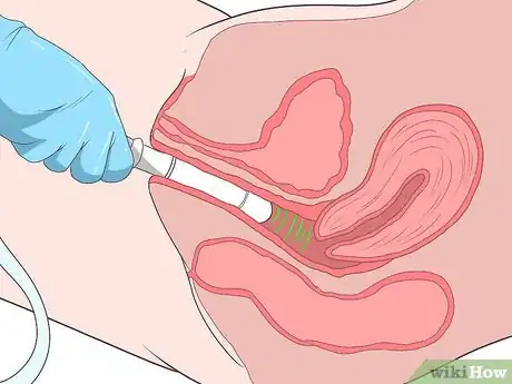 Image intitulée Recognize and Treat an Ectopic Pregnancy Step 11