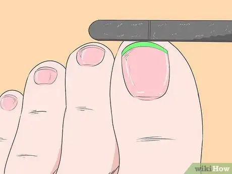 Image intitulée Fix Thick Toenails Step 5